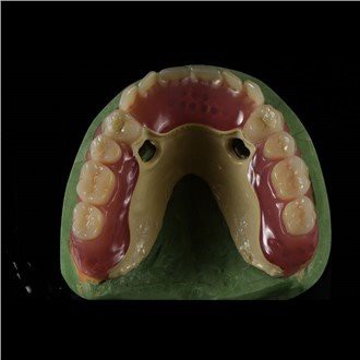 Peek Framework Dentier