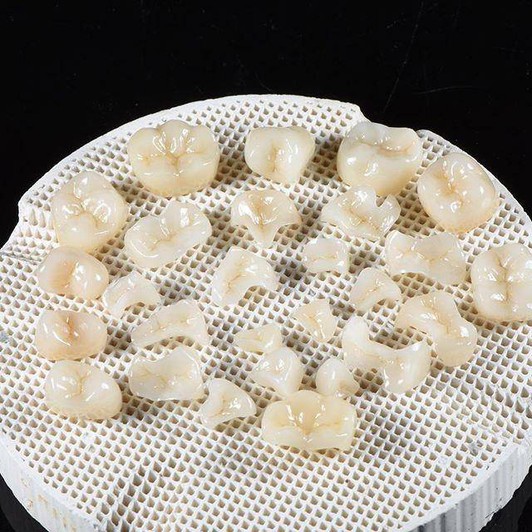 E-max inlay1 E-max inlay1