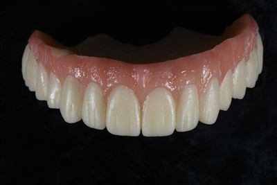 Couronne temporaire en résine acrylique